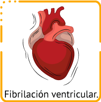 Fibrilación ventricular.